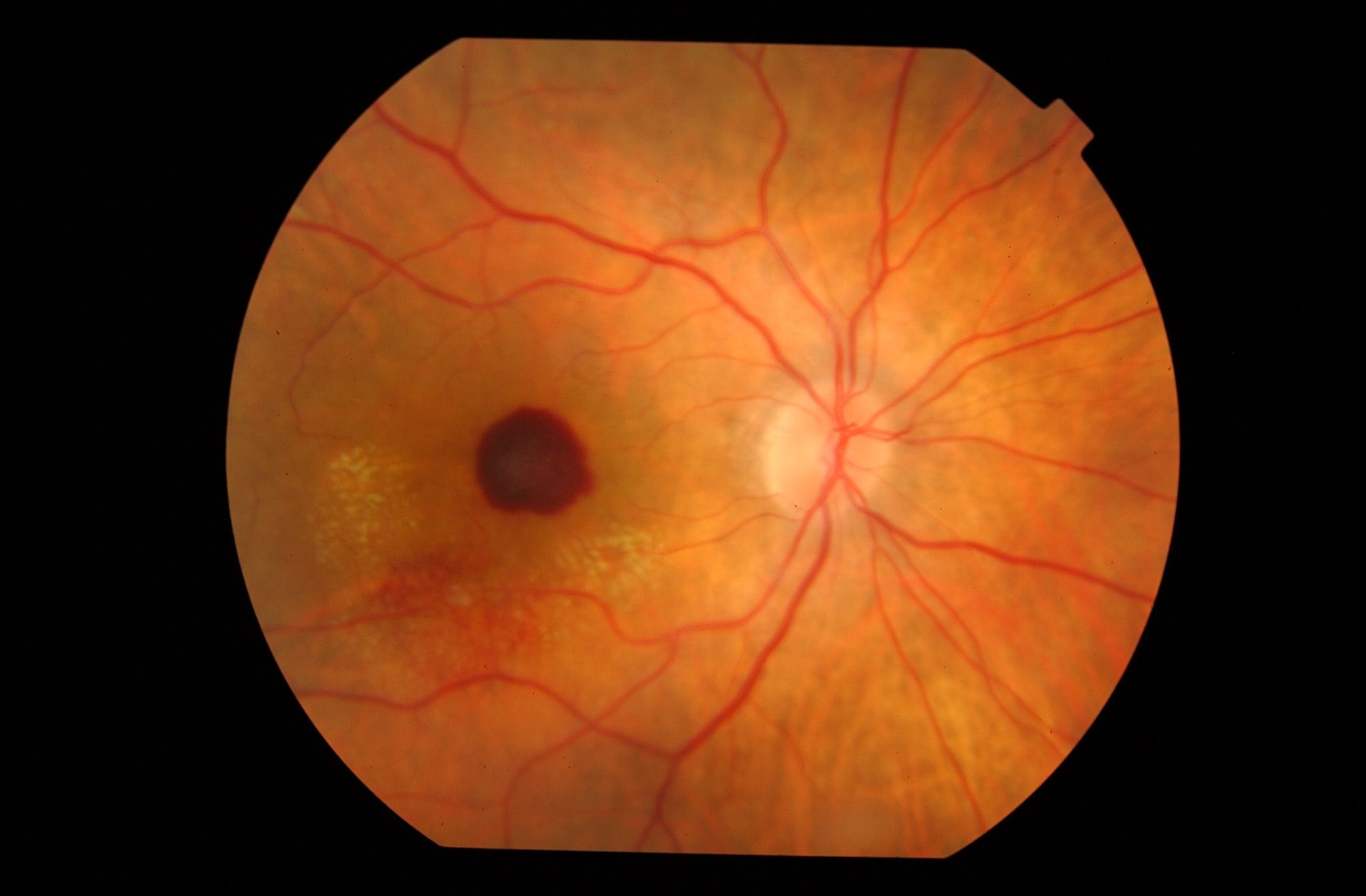 Degeneración macular húmeda en imagen de fondo de ojo