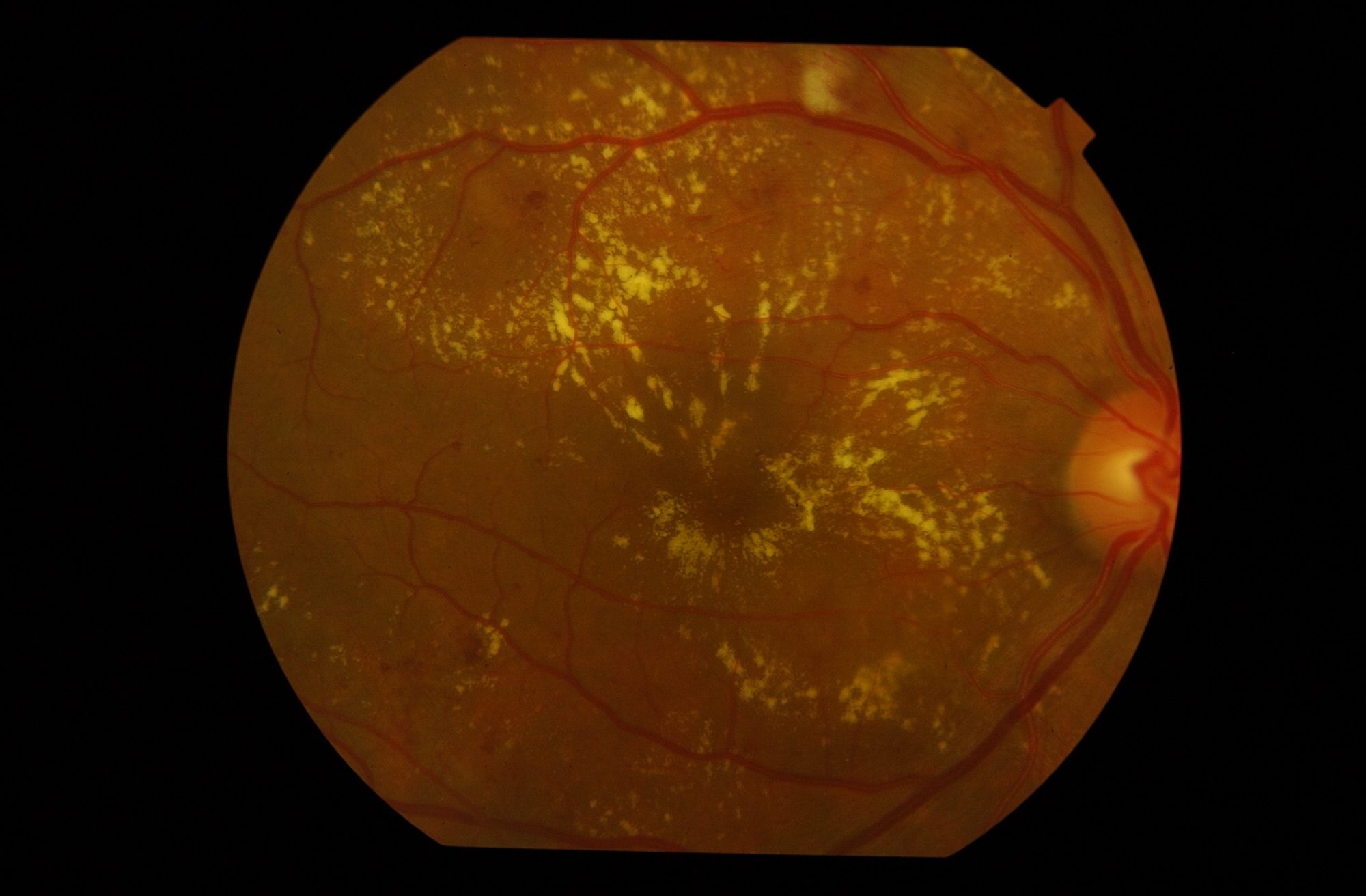 Edema macular diabético en imagen de OCT