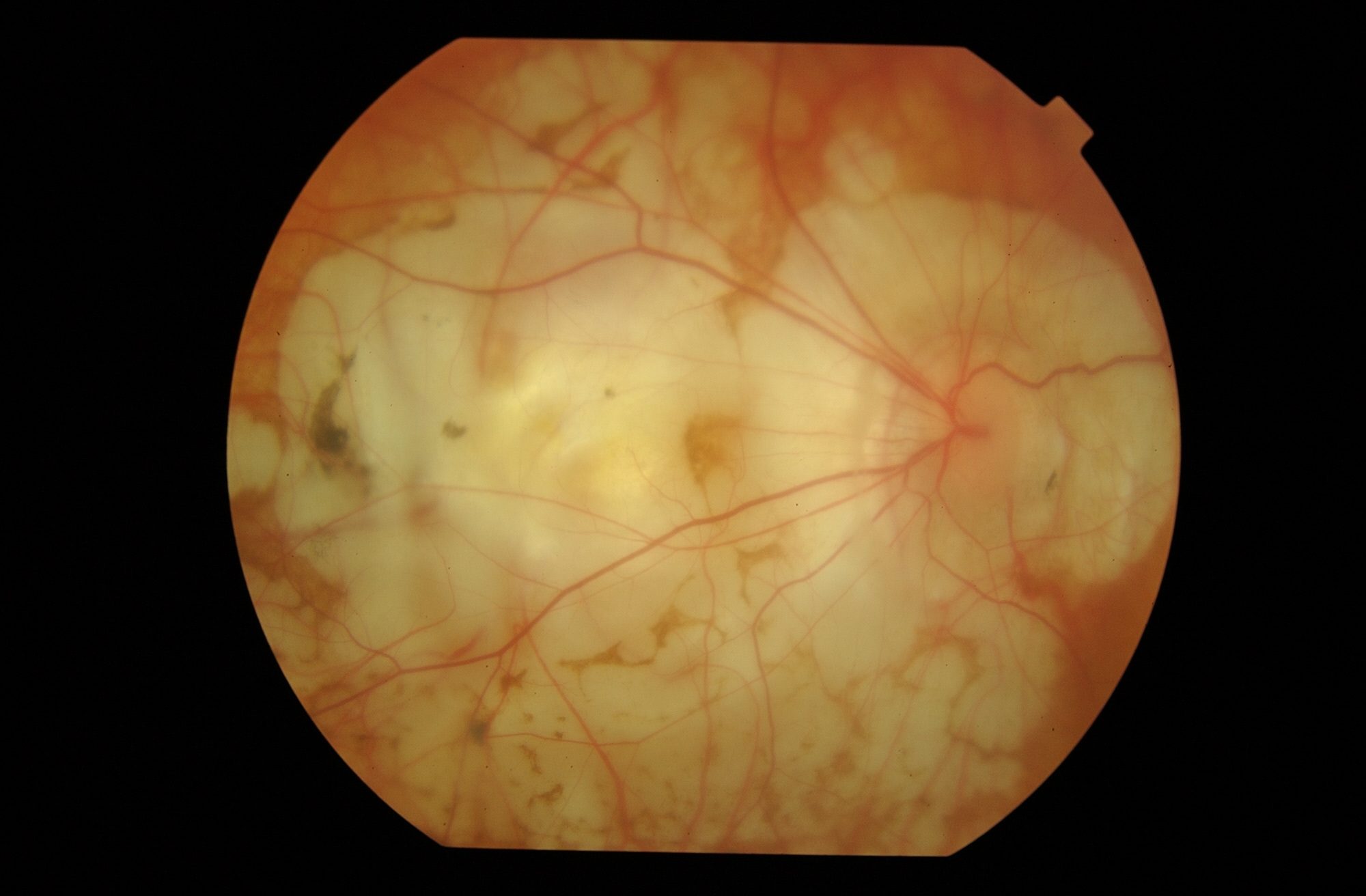 Fondo de ojo con miopía magna