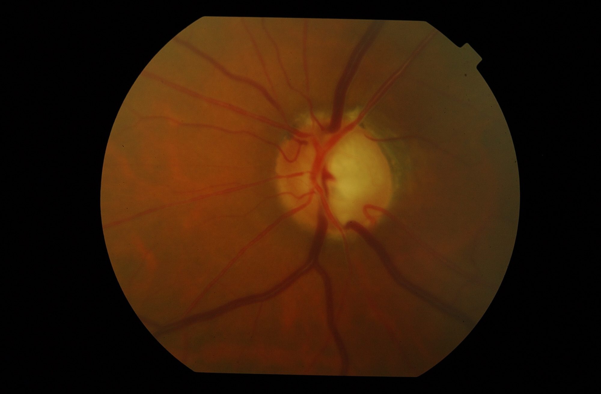 Nervio óptico con excavación glaucomatosa
