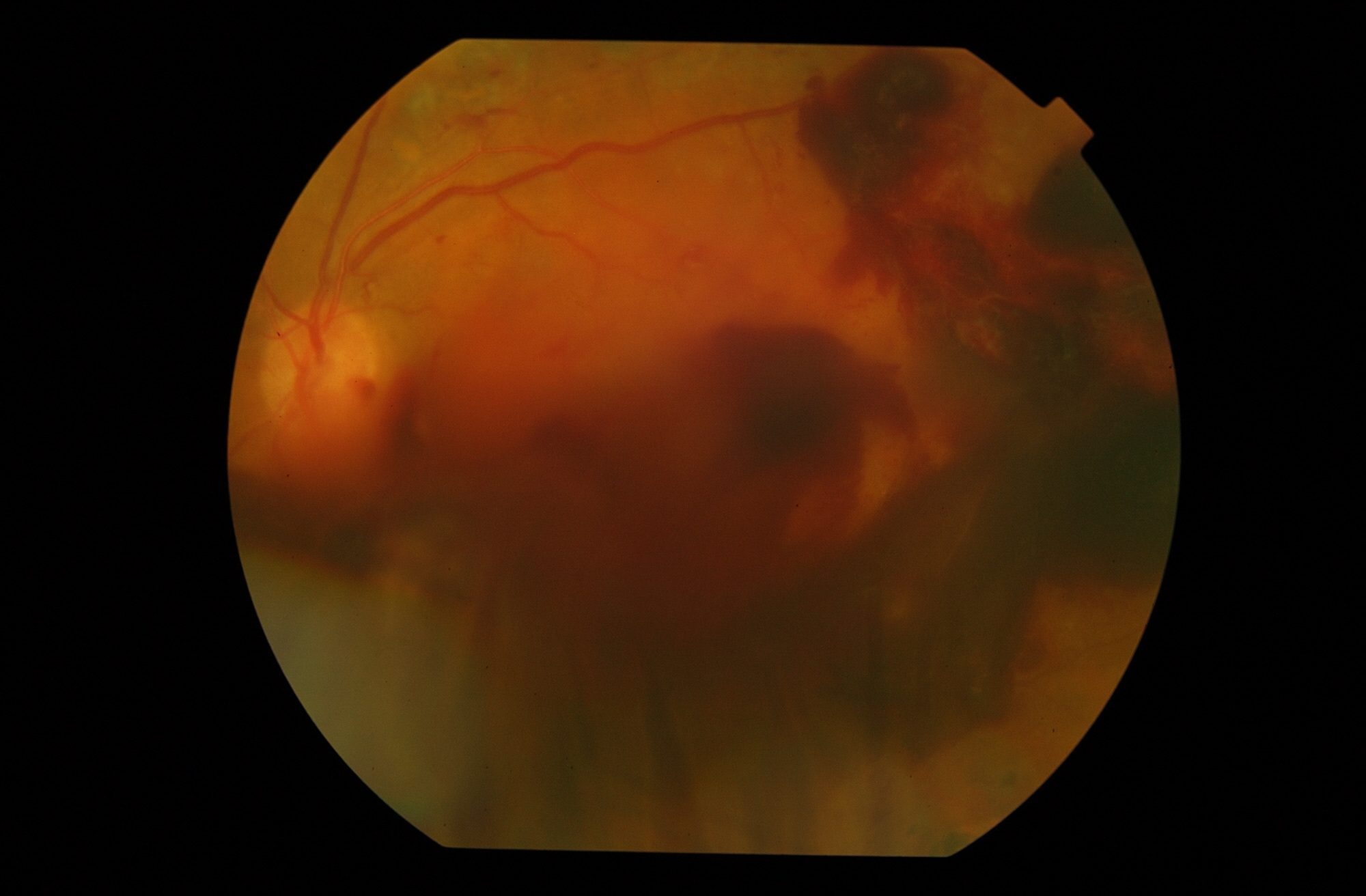 Retinopatía diabética con hemorragia intraocular