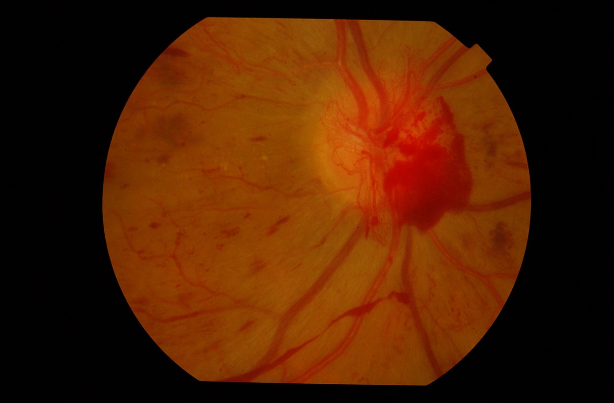 Retinopatía diabética proliferativa en retinografía
