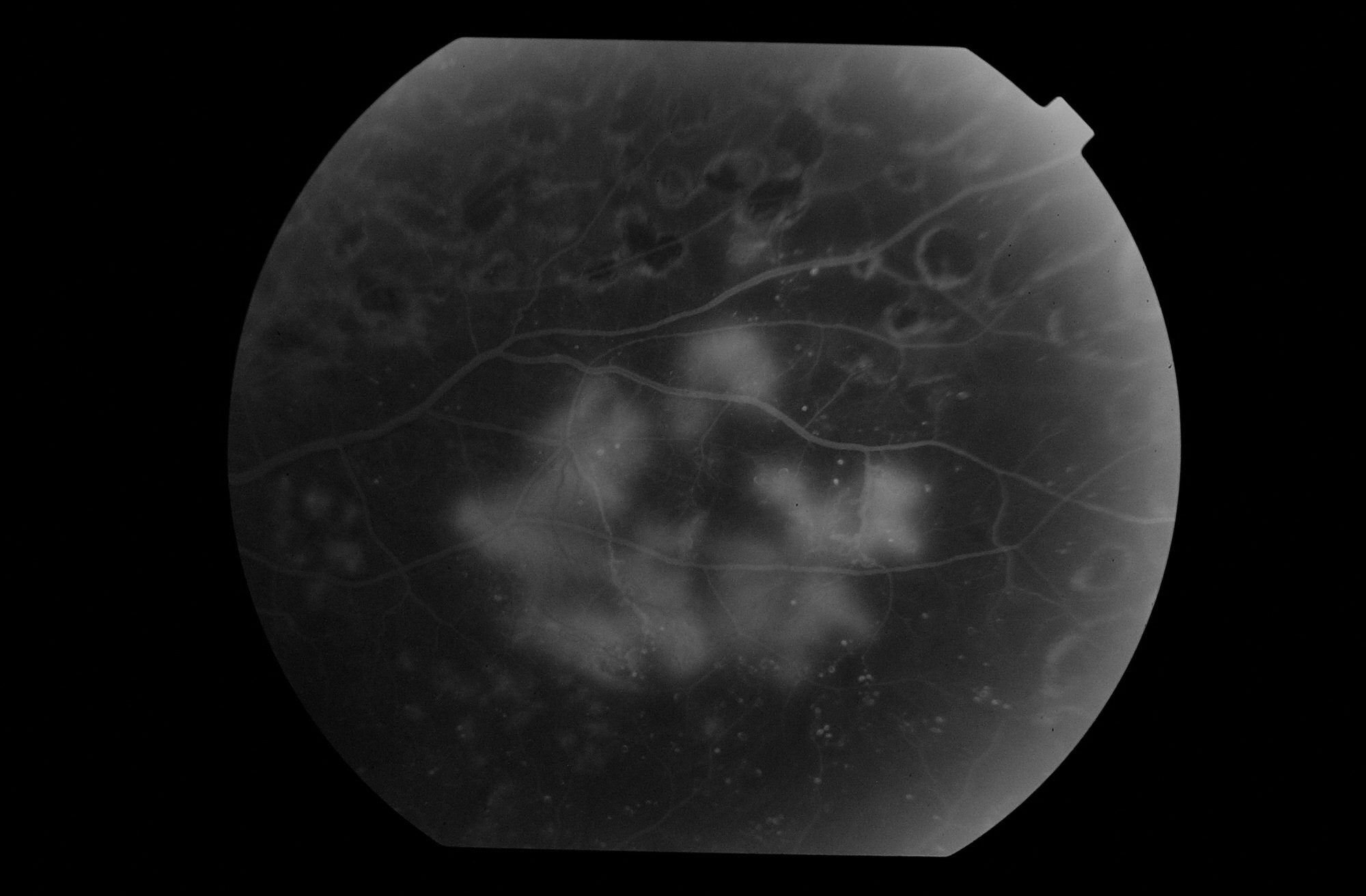 Angiografía de retinopatía diabética proliferativa